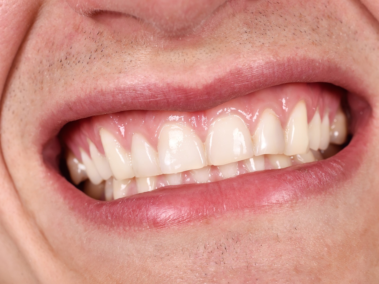 Study Hints at Why Gums Suffer With Age