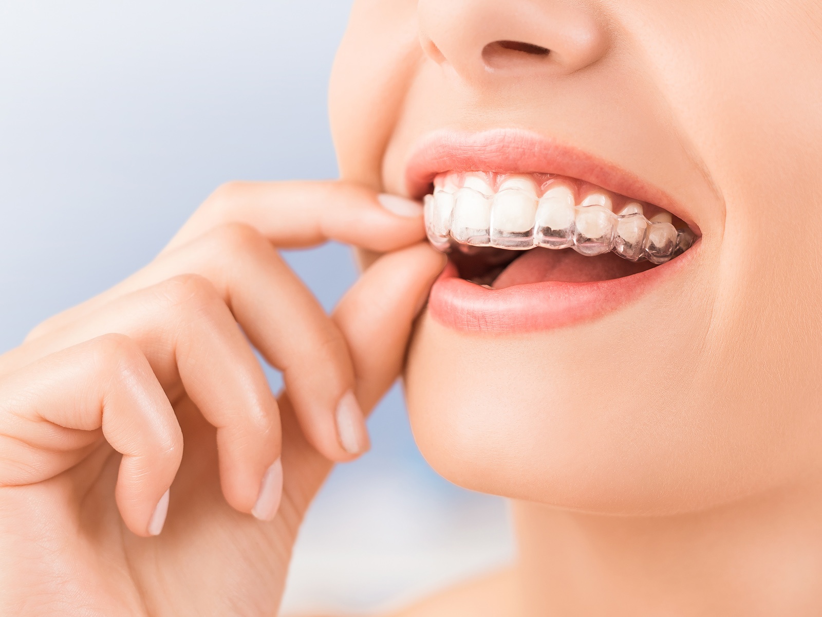 How long after Invisalign Do I need a retainer?