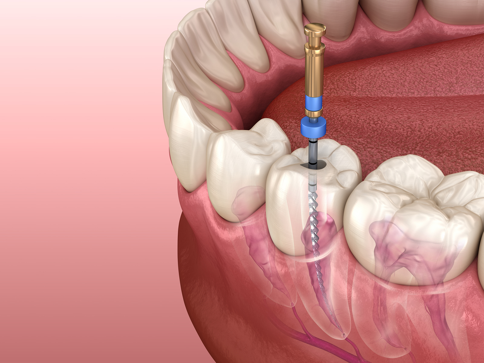 How long does a root canal last to heal?