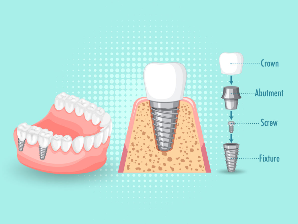 How Much Tooth Structure Is Needed For A Crown?