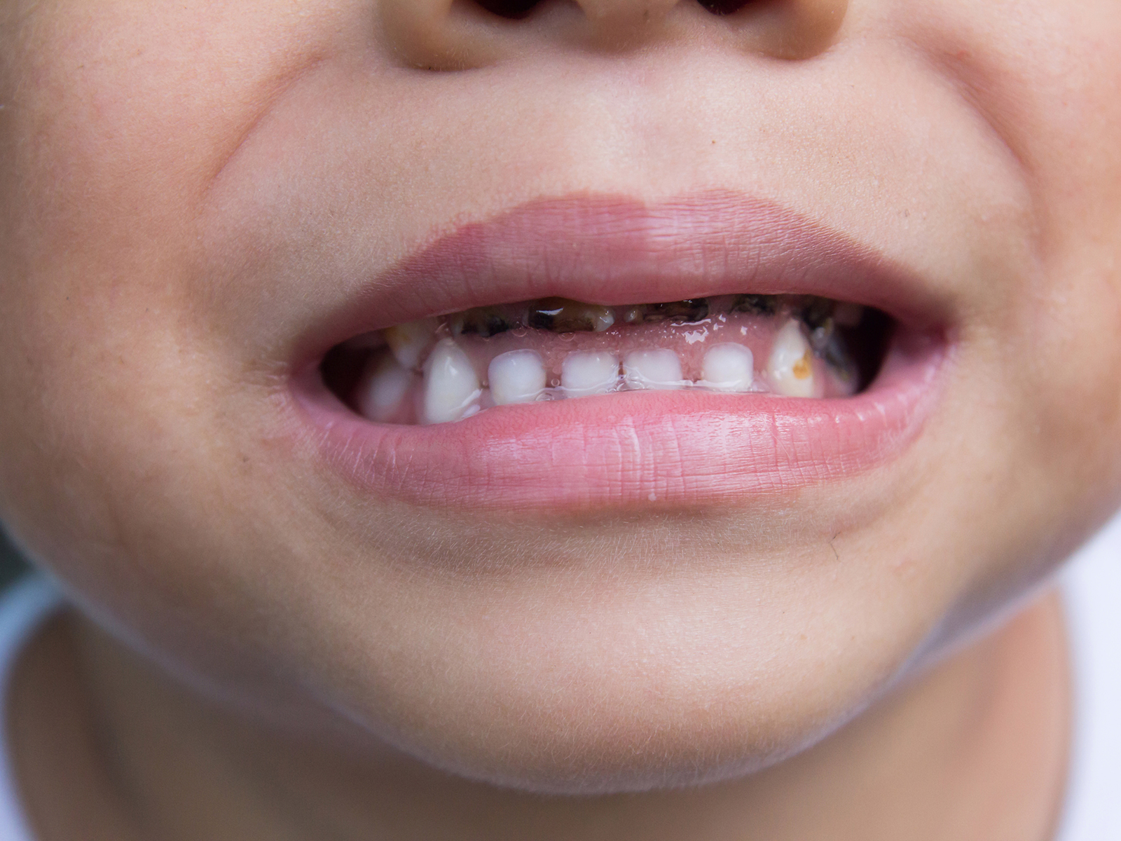 4 Ways To Reduce Early Tooth Decay In Kids