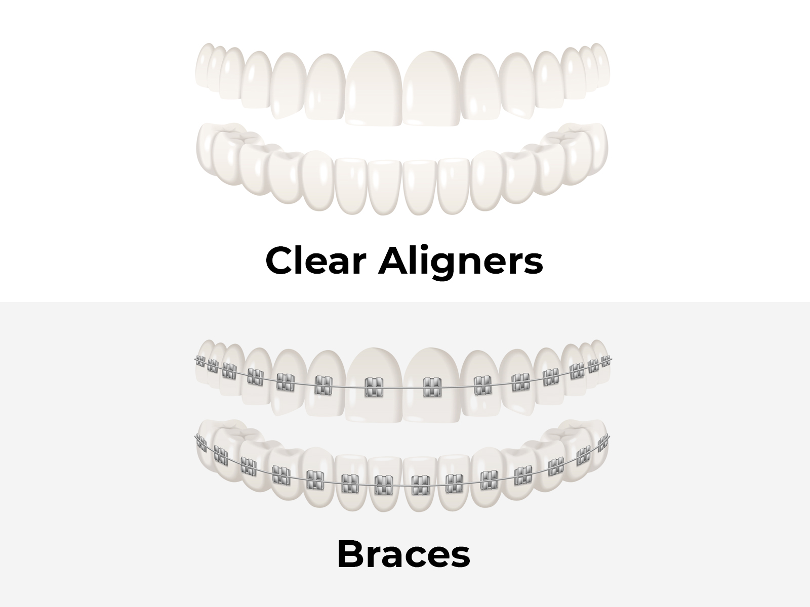 Braces Or Clear Aligners: What You Need To Know!