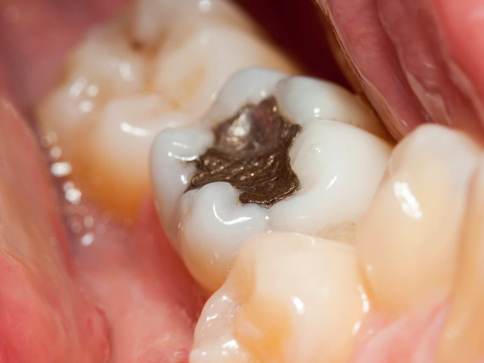 Tips For Taking Care of A Dental Filling
