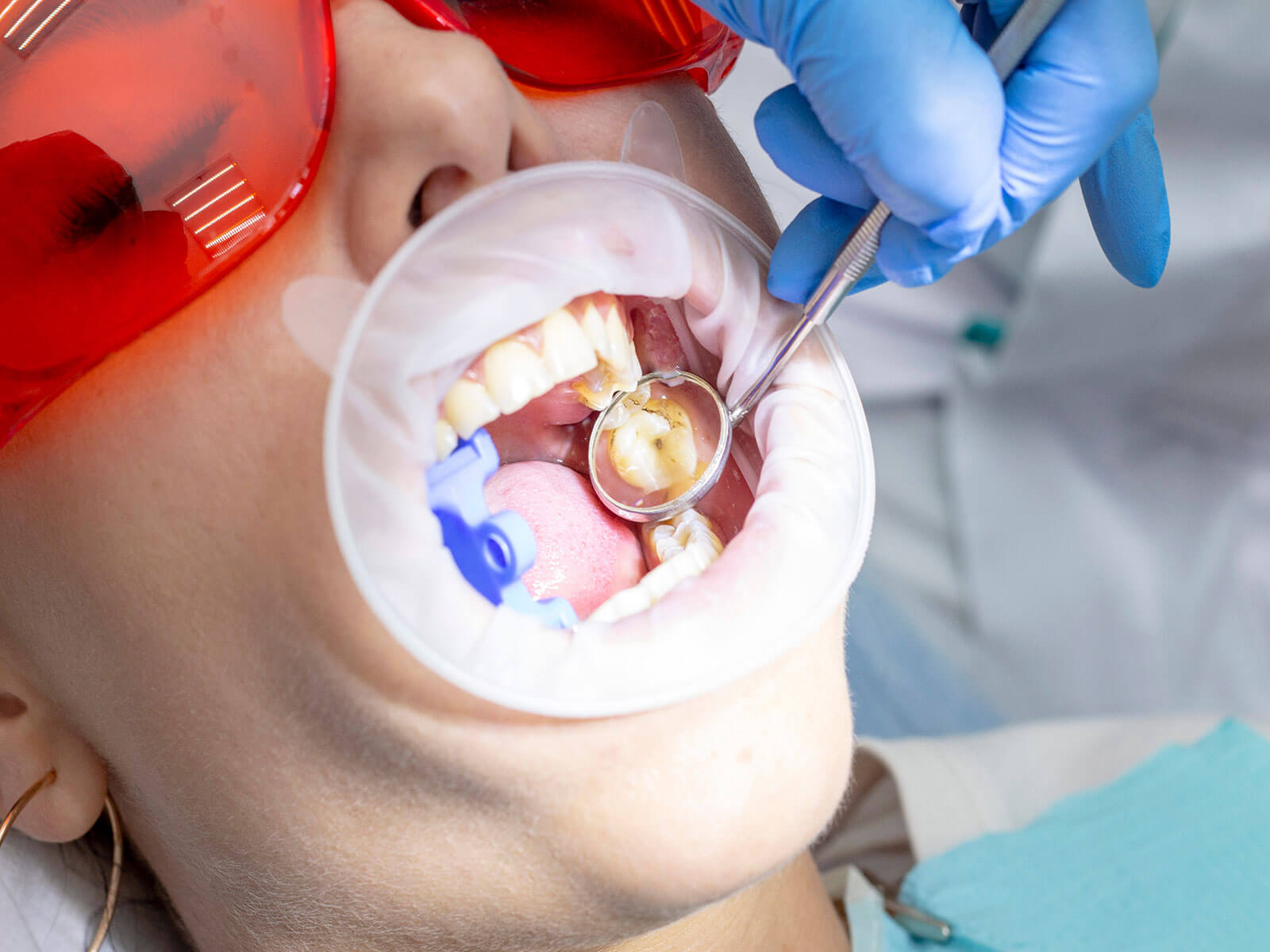 Sedation Options For Wisdom Teeth Extraction