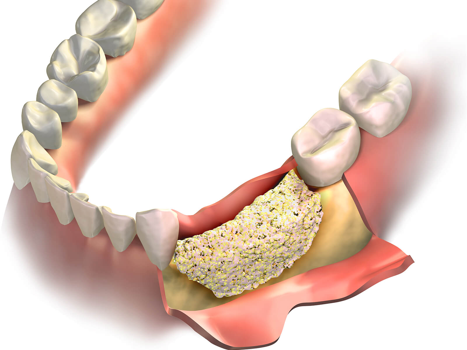 Dental Implants: Do I Need A Bone Grafting Procedure?