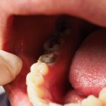 The Role of Fluoride In Strengthening Your Teeth And Preventing Decay
