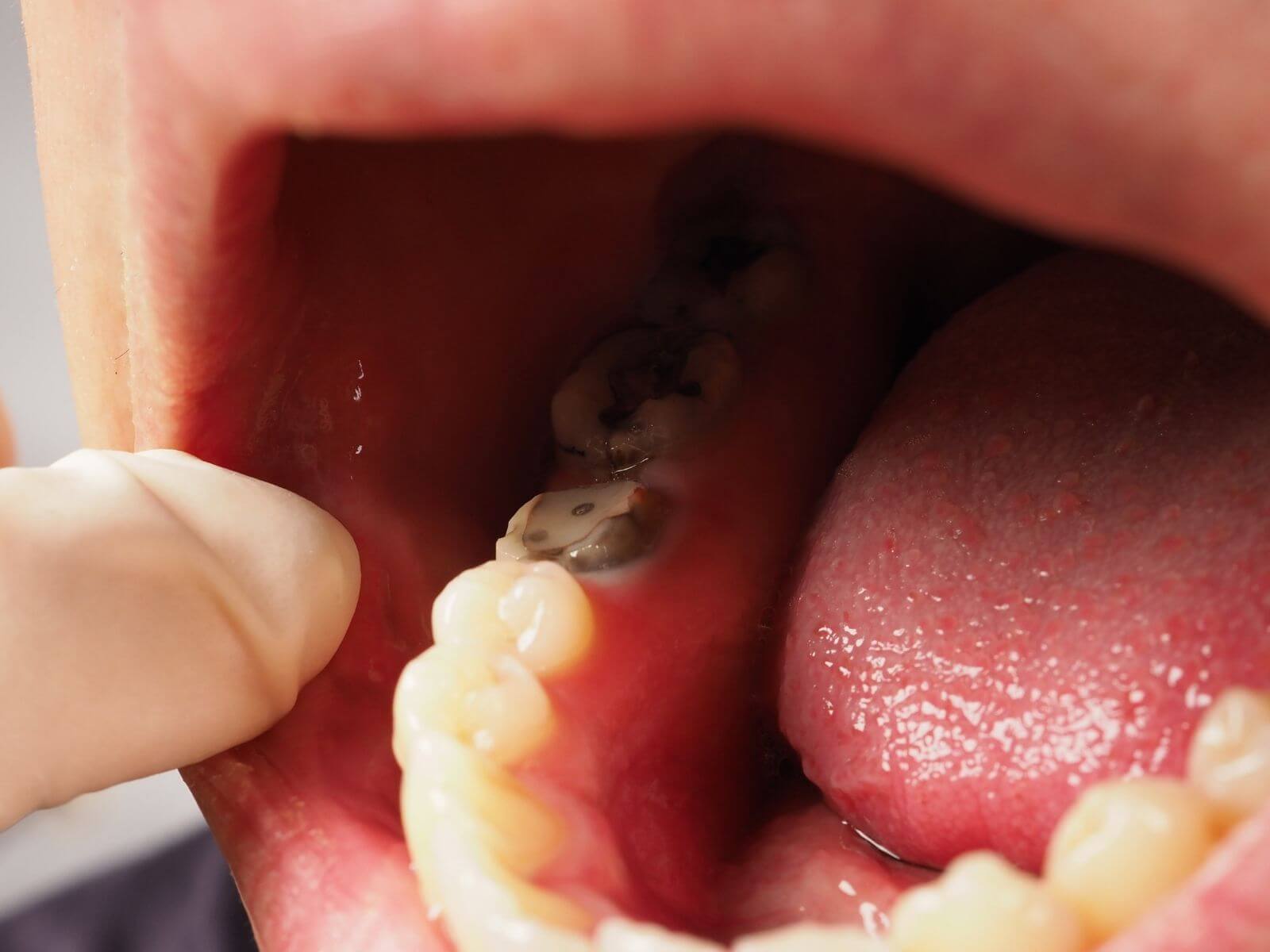 The Role of Fluoride In Strengthening Your Teeth And Preventing Decay