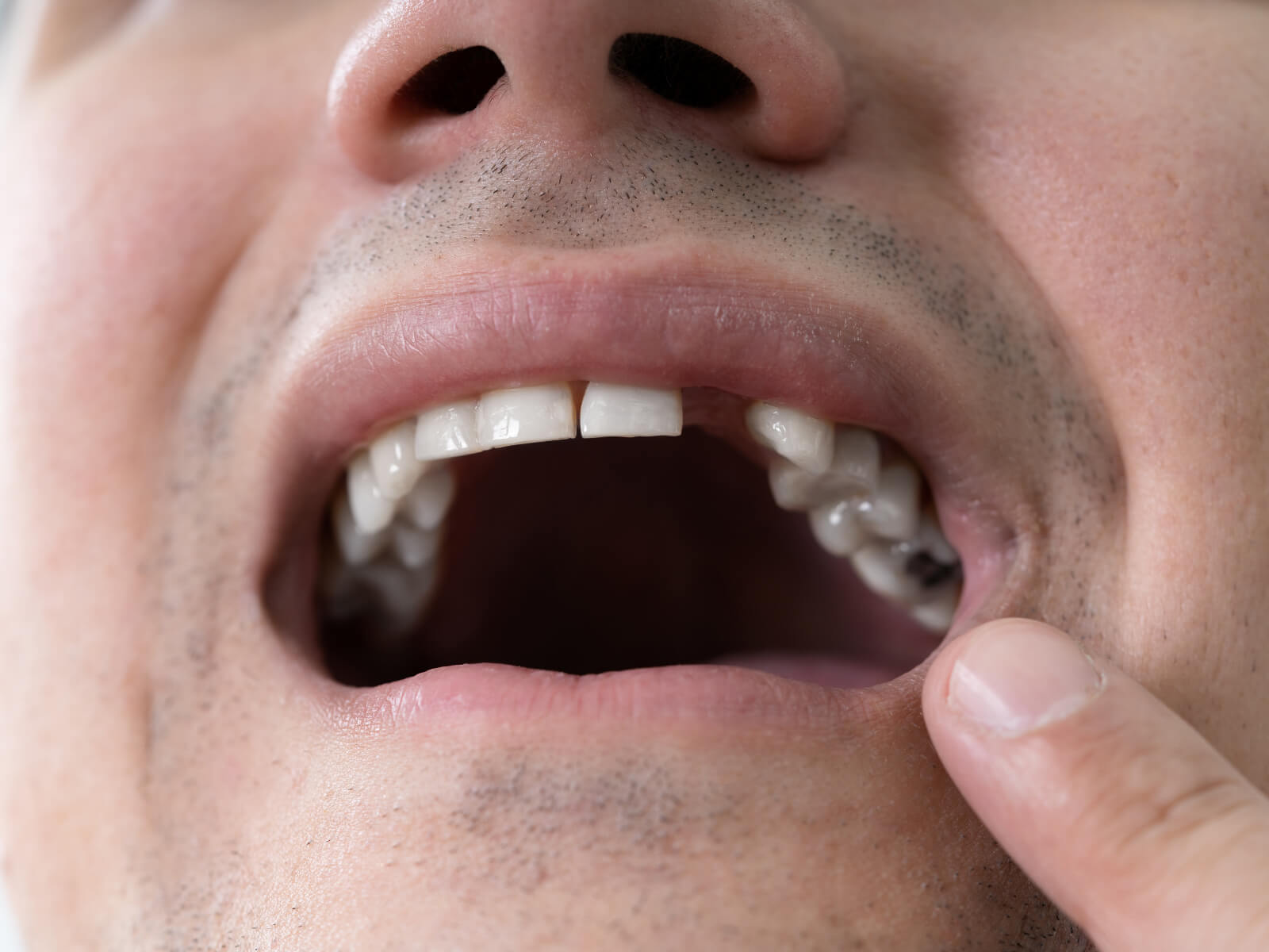 5 Mistakes To Avoid When Handling A Knocked-Out Tooth