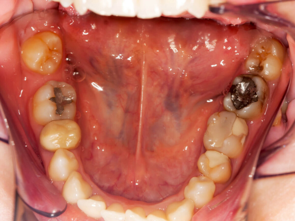 5 Signs You Might Need a Dental Filling