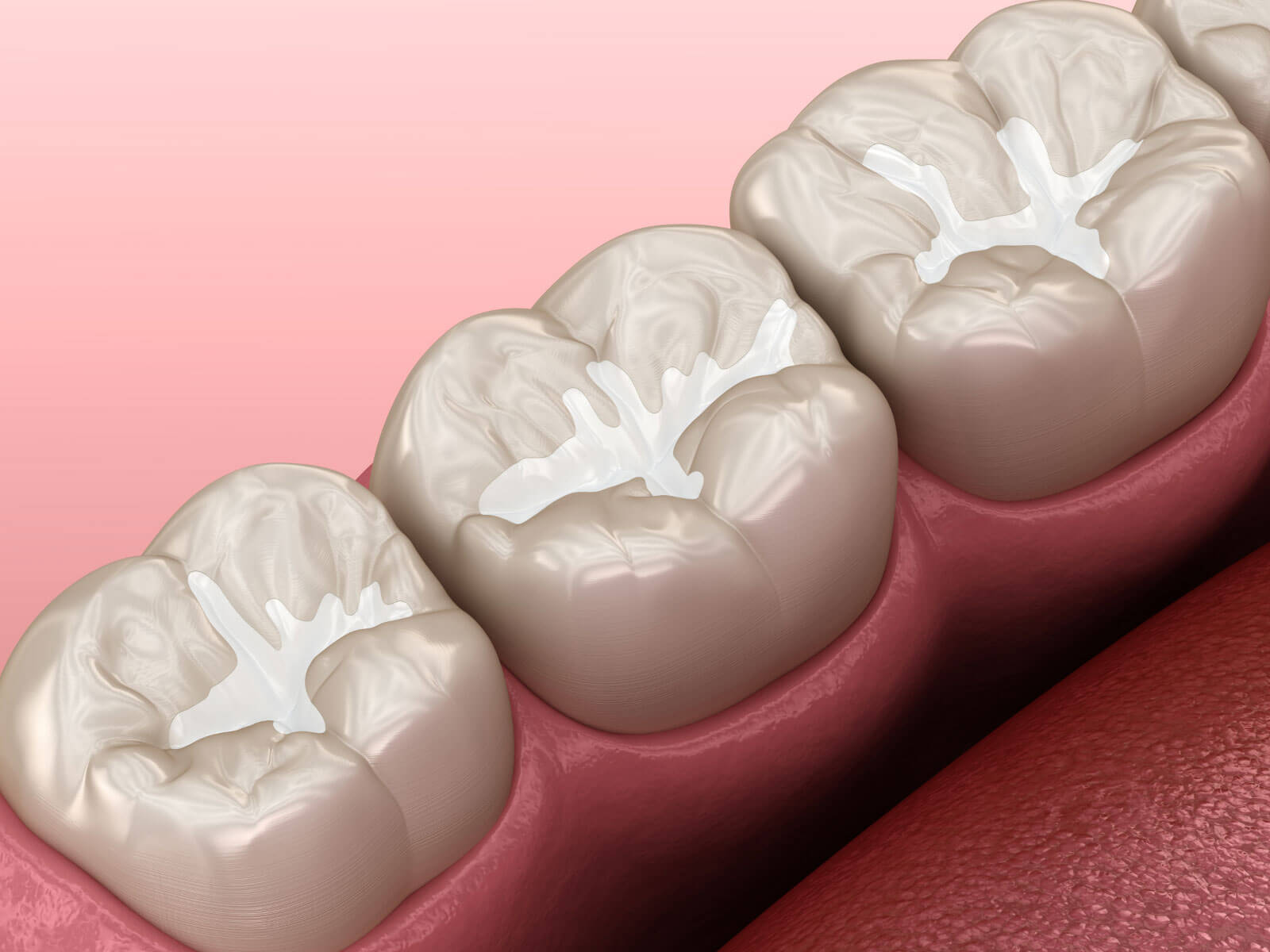 What Are Dental Sealants?