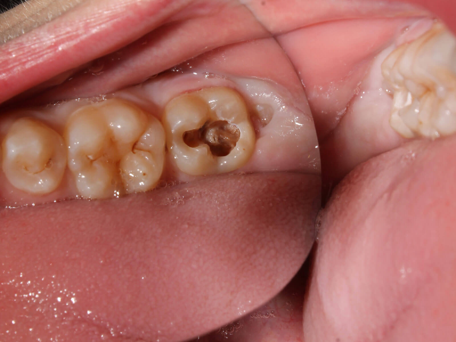 Cavity vs Stain: How to Tell the Difference