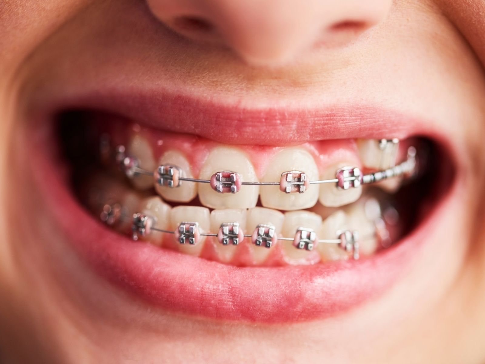 How Much Do Braces Cost in 2025? Pricing by Type and Location